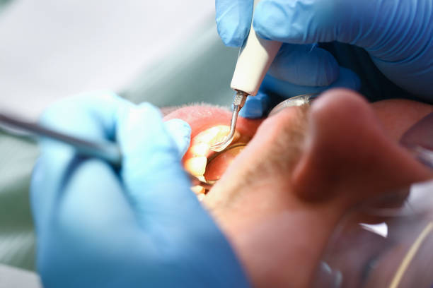 Best Broken or Chipped Tooth Repair in South San Jose Hills, CA